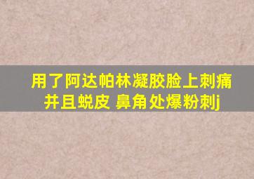 用了阿达帕林凝胶脸上刺痛并且蜕皮 鼻角处爆粉刺j